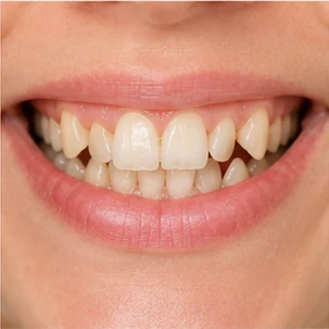 Denti storti
