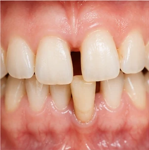 Dente che si muove