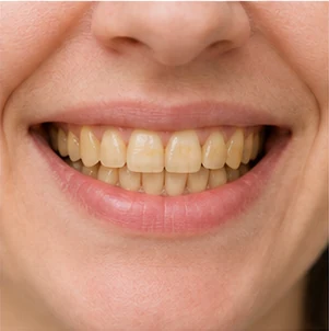 Denti gialli o macchiati
