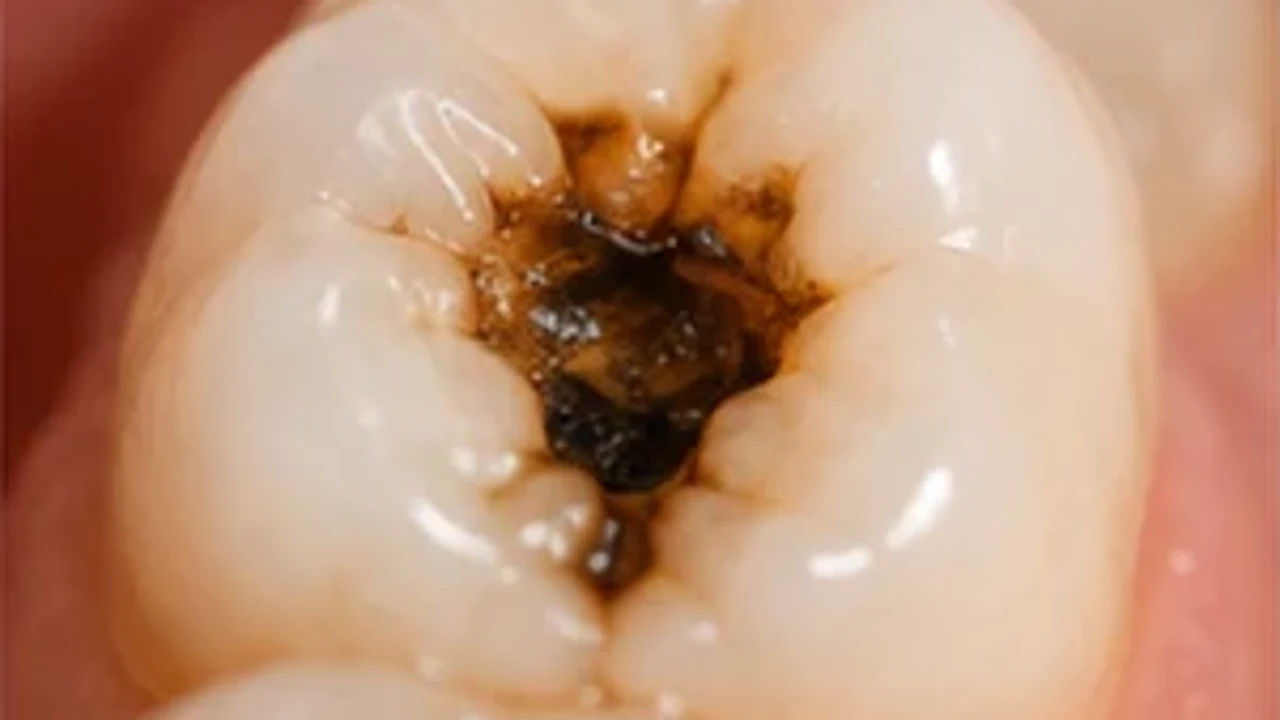 Odontoiatria conservativa: diagnosi della carie e ricostruzioni mirate.