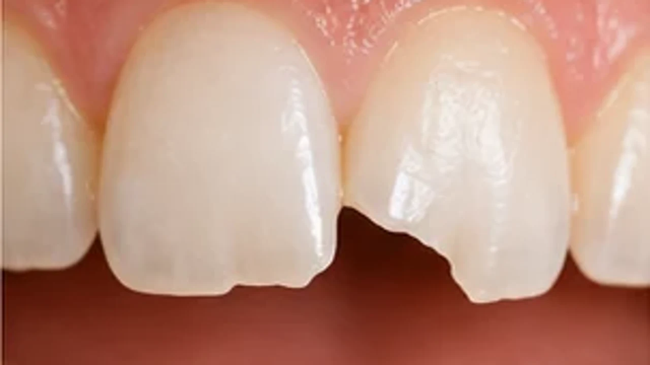 Corone dentali per proteggere e rinforzare denti molto compromessi.